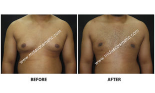 Gynecomastia