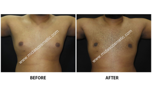 Gynecomastia