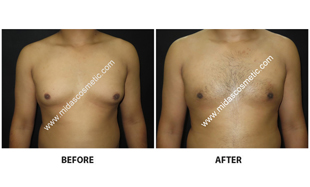 Gynecomastia