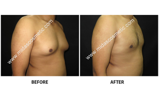 Gynecomastia