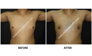 Gynecomastia