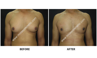 Gynecomastia