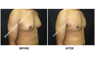 Gynecomastia