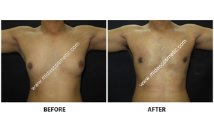 Gynecomastia