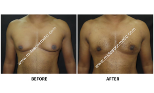 Gynecomastia