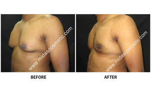 Gynecomastia