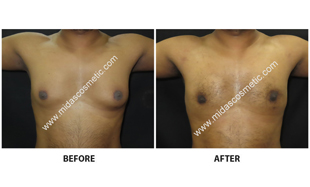 Gynecomastia