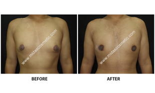 Gynecomastia