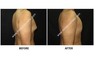 Gynecomastia
