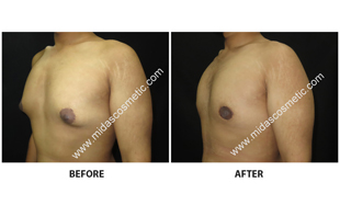Gynecomastia