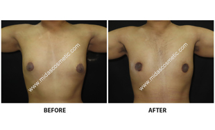 Gynecomastia