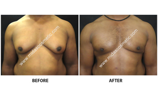 Gynecomastia