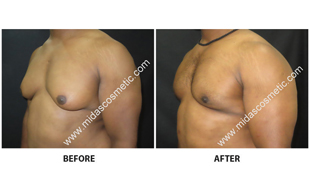 Gynecomastia