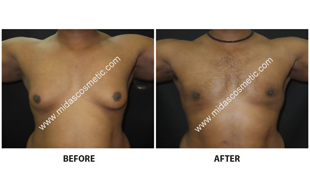 Gynecomastia