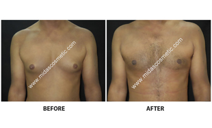 Gynecomastia