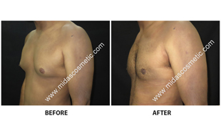 Gynecomastia