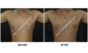 Gynecomastia