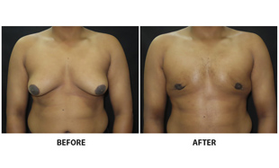 Gynecomastia