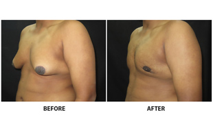Gynecomastia