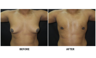 Gynecomastia
