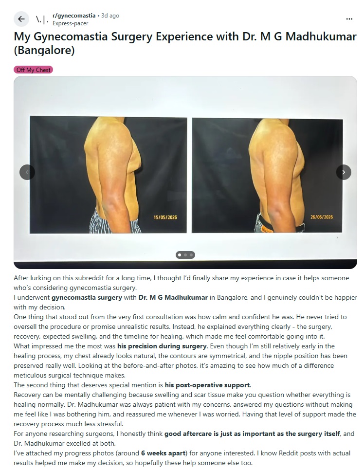 My Gynecomastia Surgery Experience