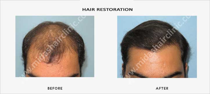 Midas Cosmetic : Hair transplant in Bangalore | Hair transplant in India | Hair  transplantation in India | FUE Hair transplant in India | FUE Hair  transplant in Bangalore | Best Hair